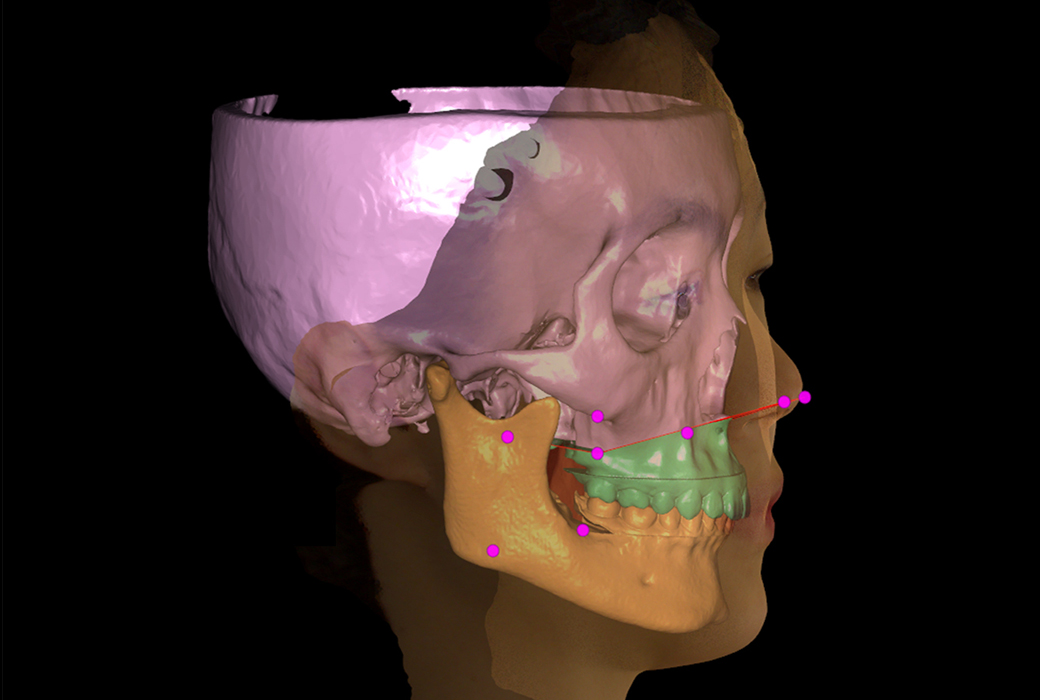 數(shù)字化正畸外科