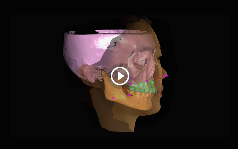 面部三維掃描儀,3D臉部三維掃描儀,人臉三維掃描整形,3D數(shù)字整形,面部3D填充整形,頜面外科整形,3D智能面部掃描系統(tǒng)